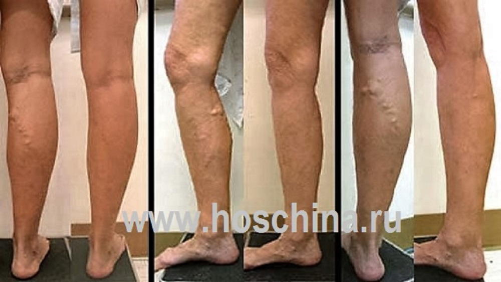 Лечение атеросклероза нижних конечностей в китае thumbnail